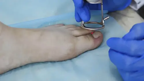 îndepărtarea unghiilor încarnate